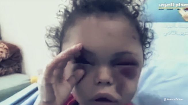 Krieg im Jemen: Kind wird zum Symbol der Grausamkeiten